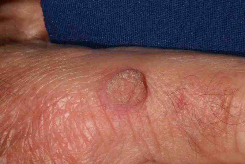 Warts : Types, Treatments, Causes - WebMD