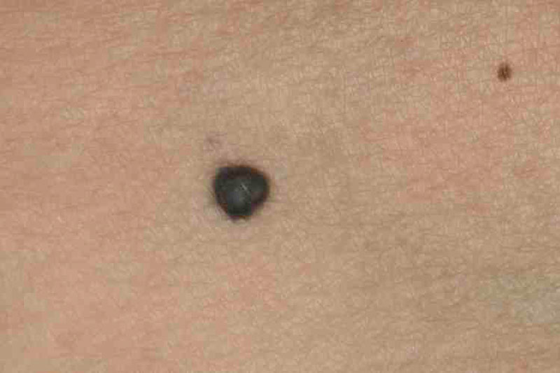 Blue dots under skin - Undiagnosed Symptoms - MedHelp
