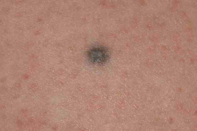 Small Black Dot On Skin Pictures Photos