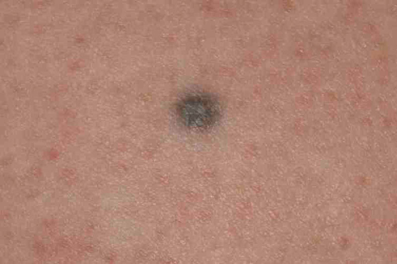 small black dot on skin #10