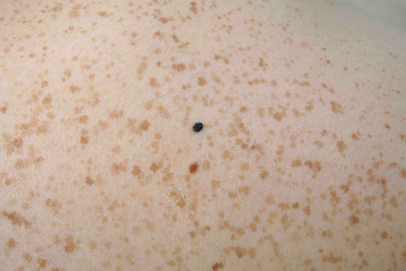 Black Freckle Skin Cancer