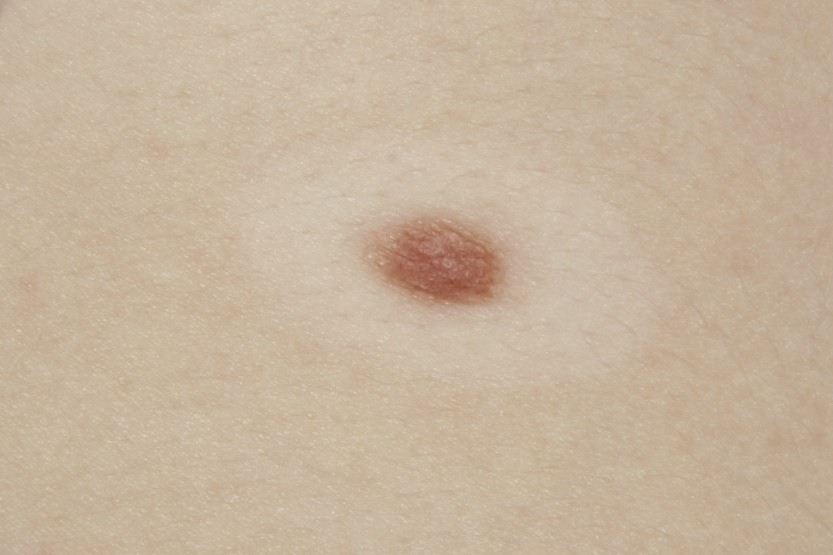 Halo Nevus Clinical Presentation: History, Physical, Causes