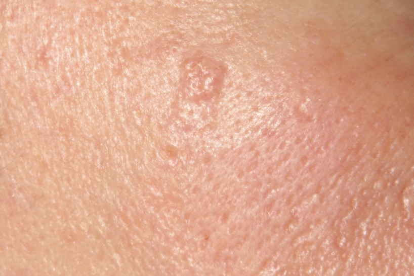 Sebaceous Cysts On Penis 55