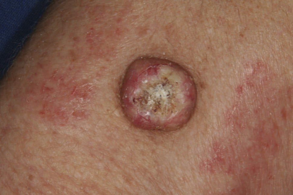 Picture of Squamous Cell Carcinoma - WebMD