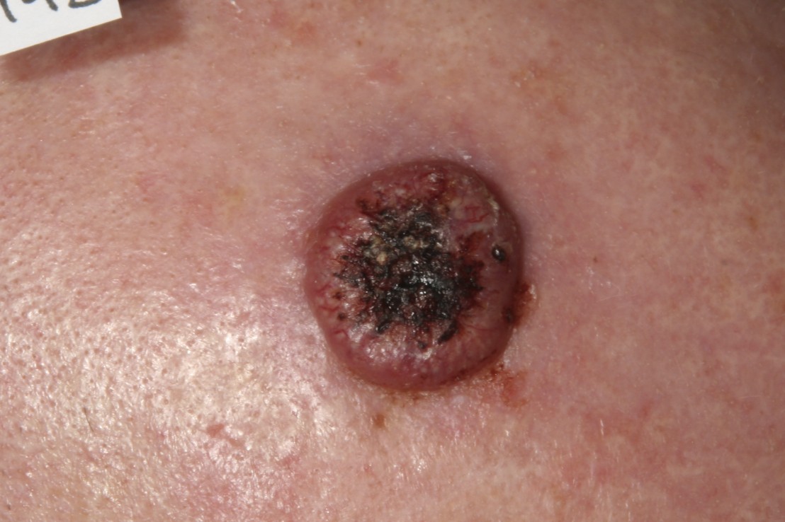 Picture of Squamous Cell Carcinoma - WebMD