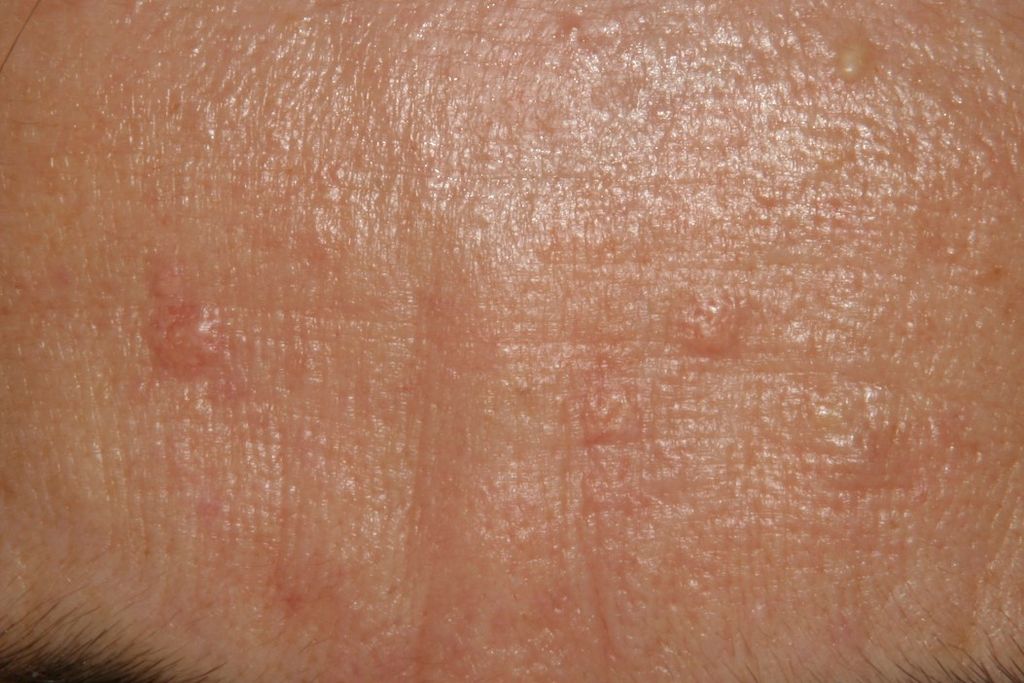 sebaceous hyperplasia 07