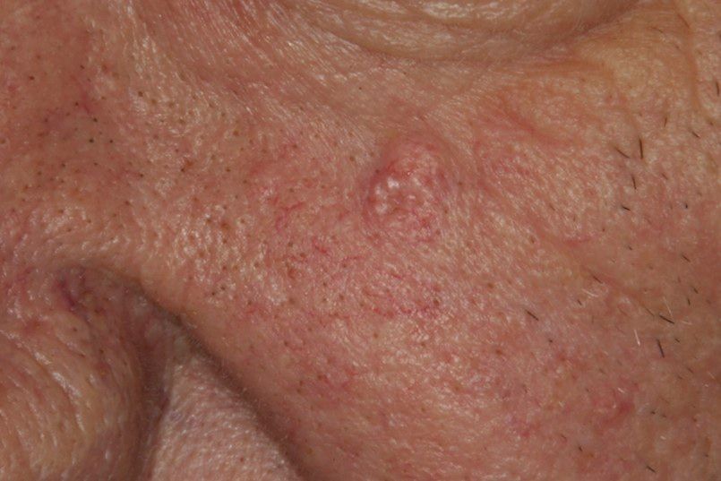 sebaceous hyperplasia 08