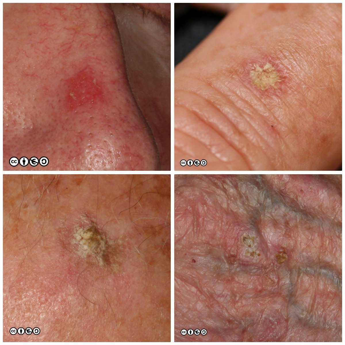 Actinic keratosis AK composite