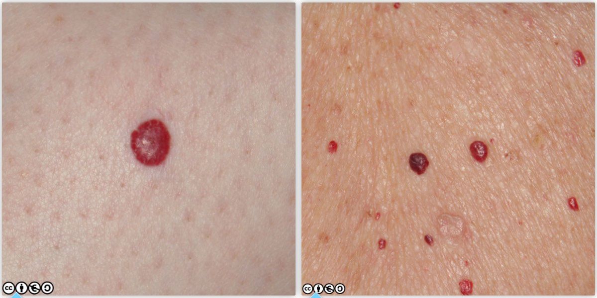 Cherry angiomas 2