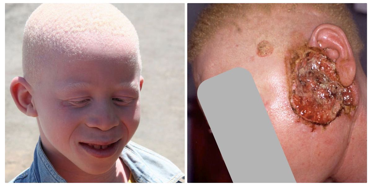 albino v2