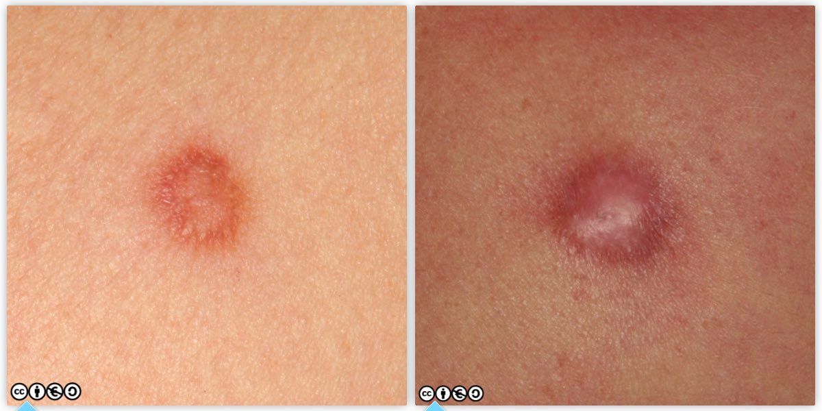 dermatofibroma pair