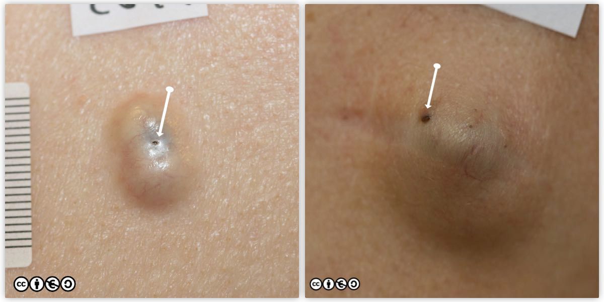 epidermal cysts