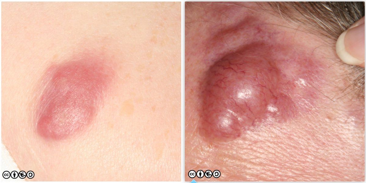 lymphoma images 2