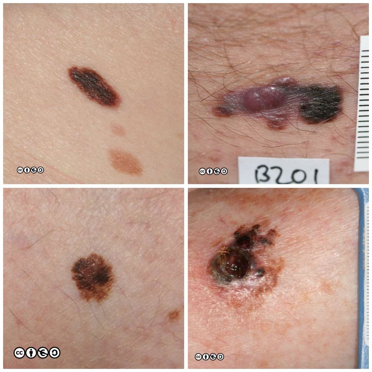 melanoma composite