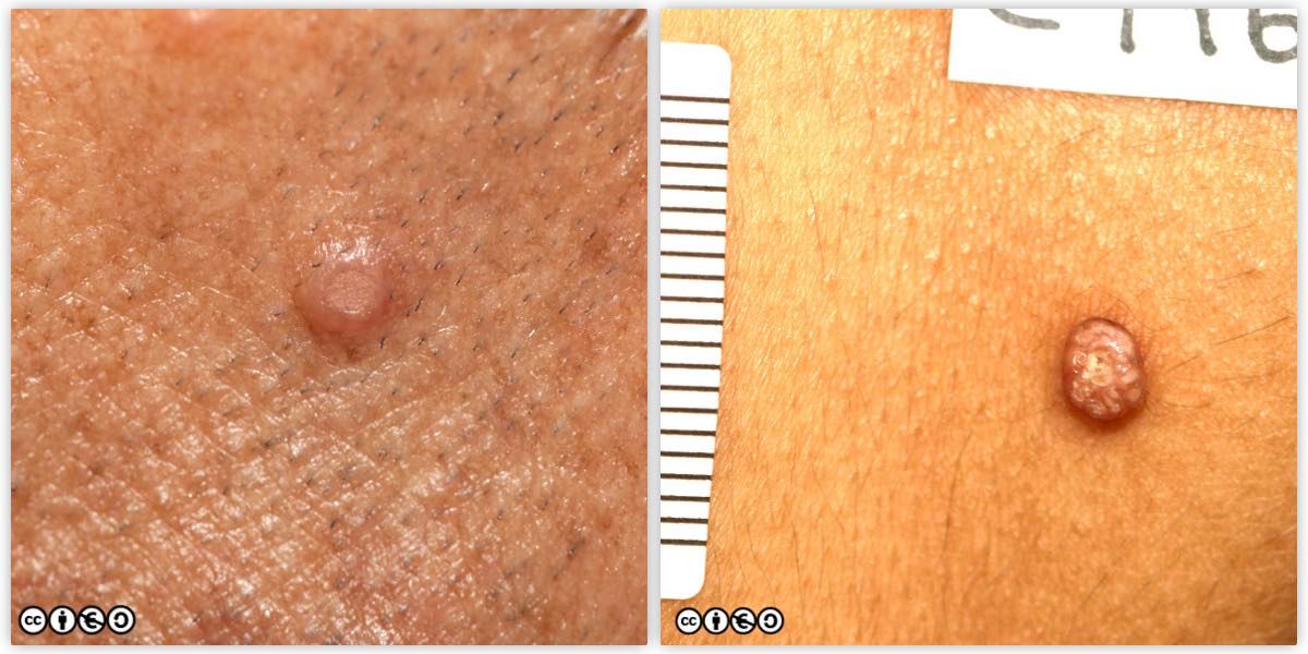 molluscum pair
