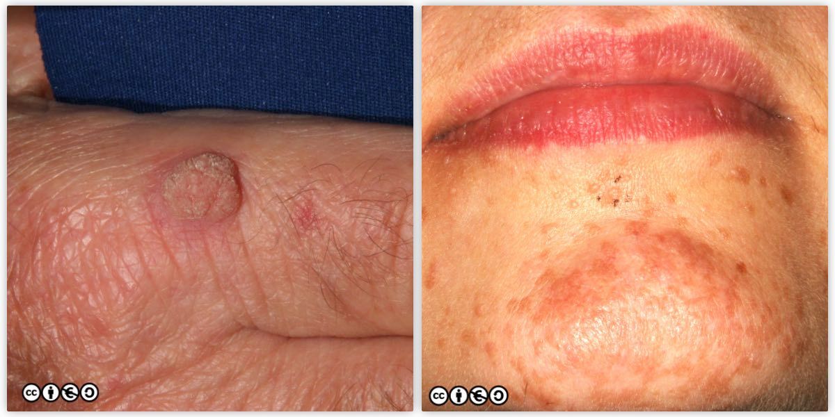 more warts pair