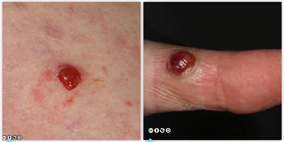 pyogenic granuloma pair