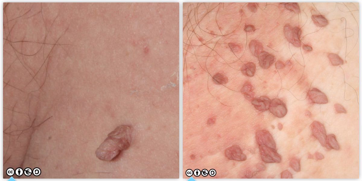 skin tags pair