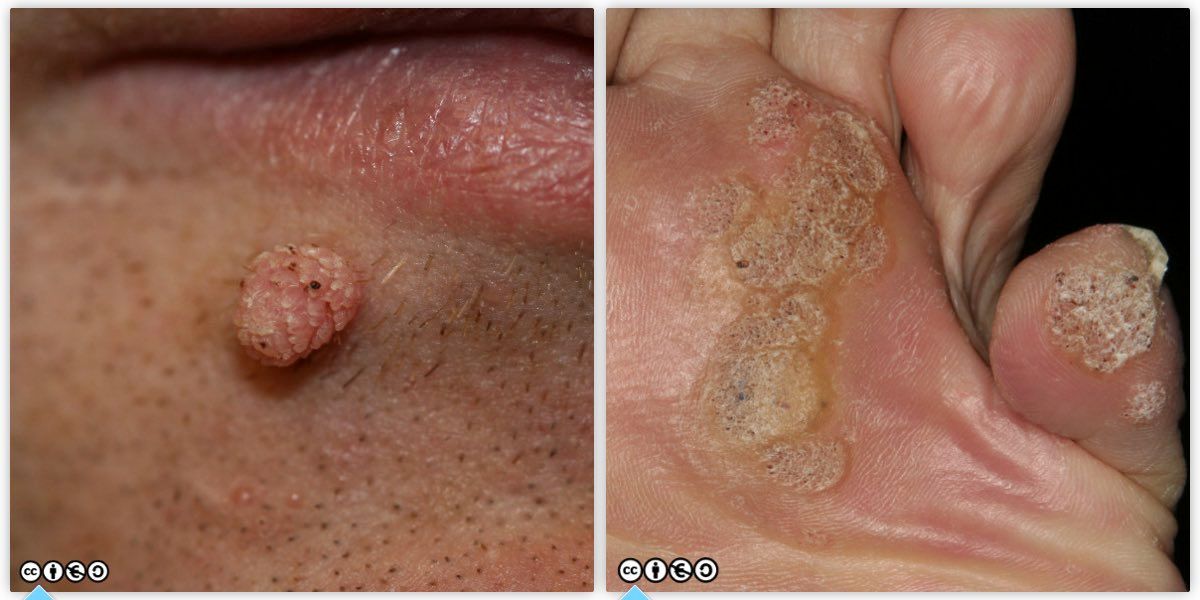 viral warts pair
