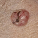 basal-cell-carcinoma-08