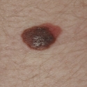 malignant-melanoma-10