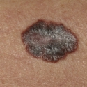 malignant-melanoma-16