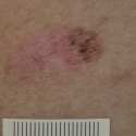 malignant-melanoma-18