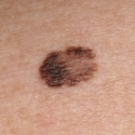 malignant-melanoma-20