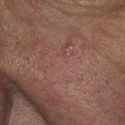sebaceous-hyperplasia-08