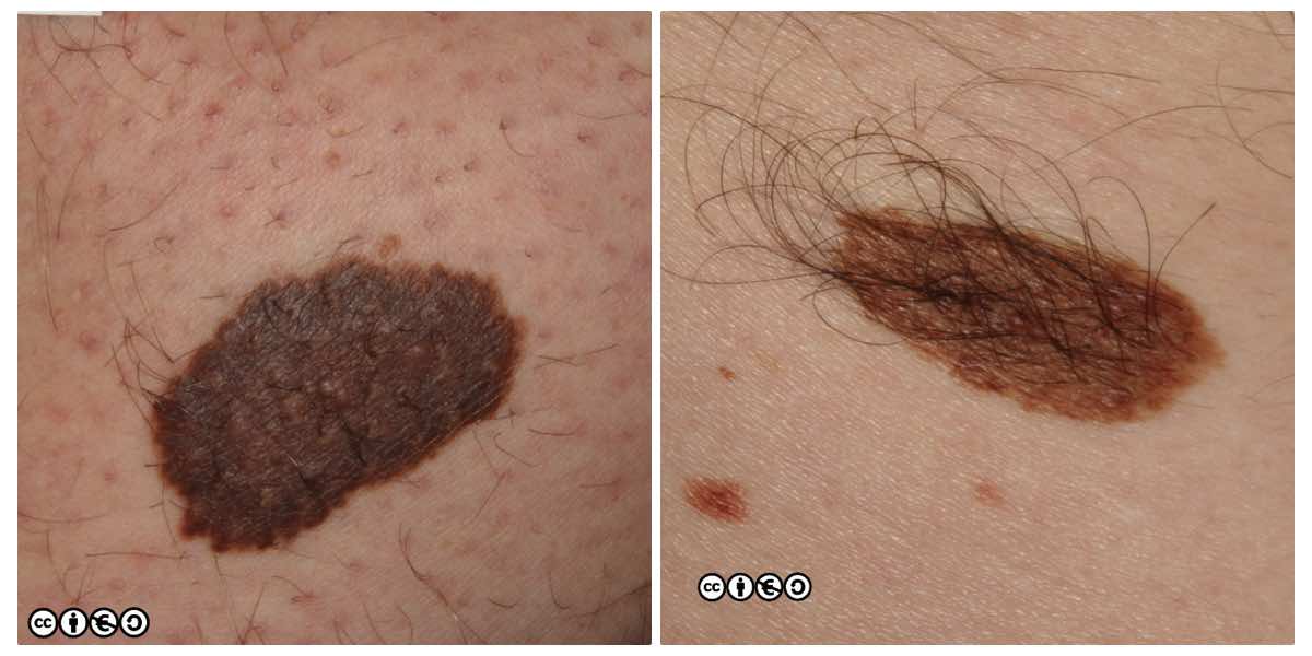 congenital nevus melanoma