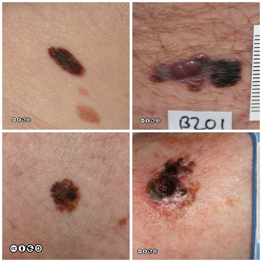 melanoma-skin-cancer-909