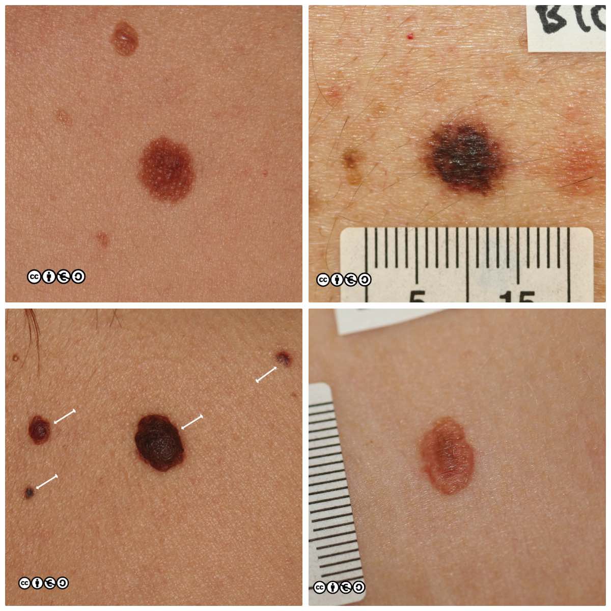 benign cancer mole