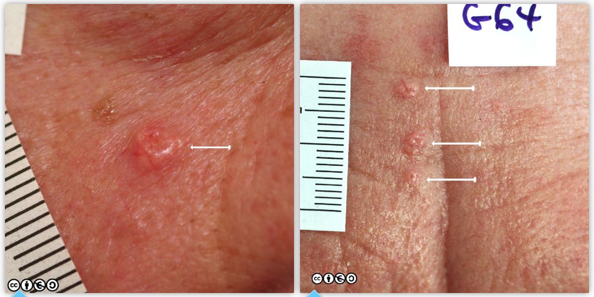 Multiple basal cell papillomas. Skin cancer benign mole
