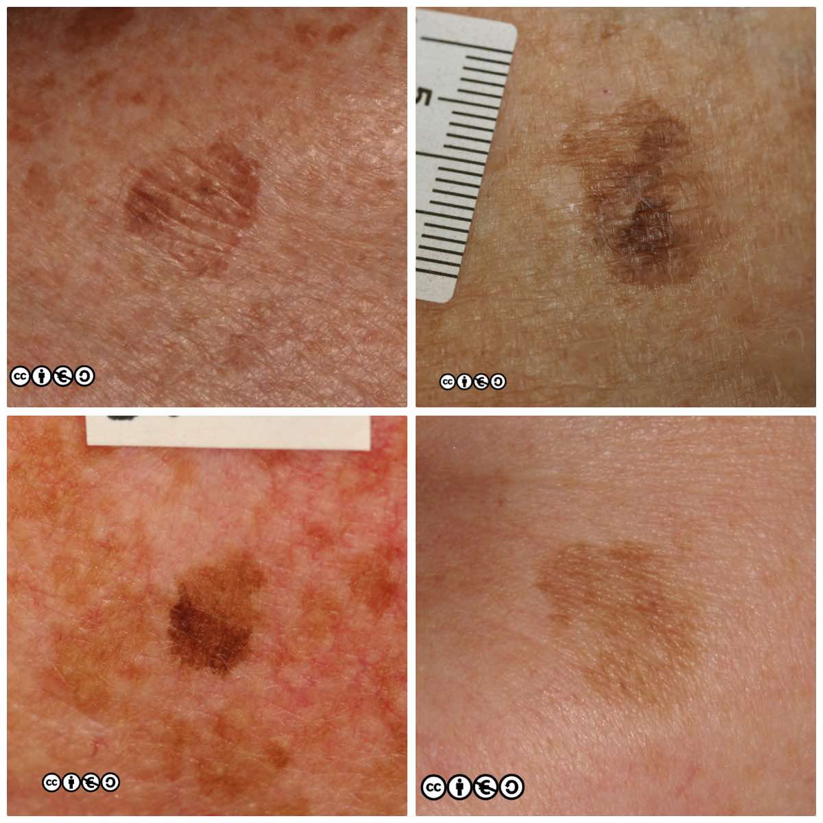 Melanoma Light Brown Patch - Infoupdate.org